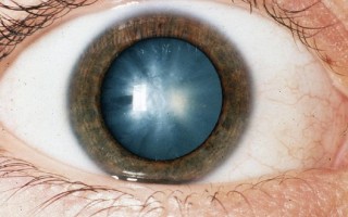 Как лечится катаракта глаза?