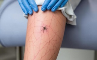 Комплексный подход к лечению сосудистых звездочек на ногах
