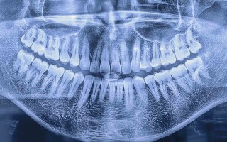 Панорамный снимок зубов: все, что нужно знать