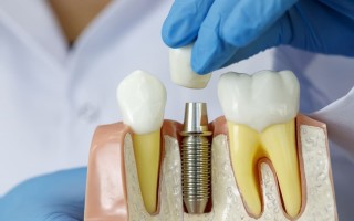 От чего зависит стоимость имплантации зубов?