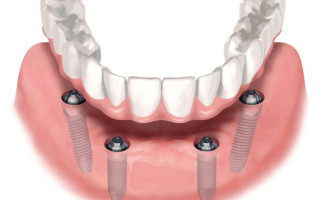 Имплантация зубов под ключ методом all-on-4