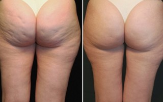 Какое ухо лучше проколоть два раза девушке?