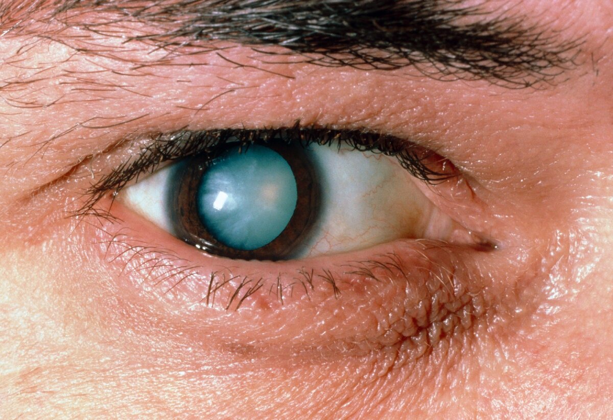 Как лечится катаракта глаза?