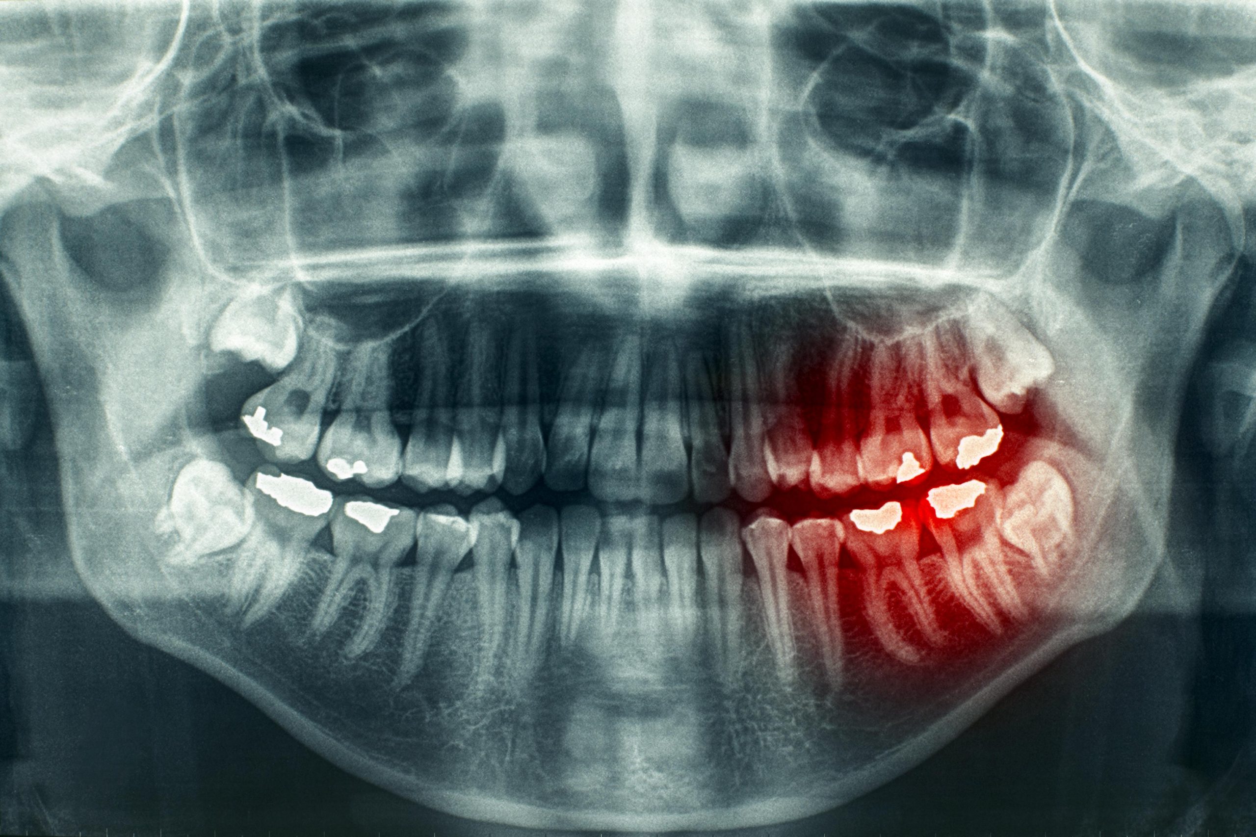 Панорамный снимок зубов: все, что нужно знать
