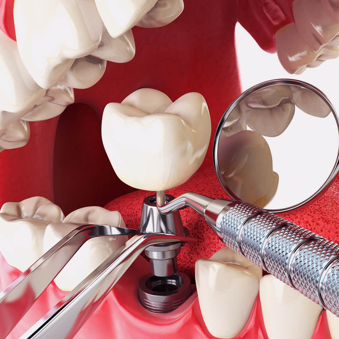 Имплантация зубов: востановление улыбки и здоровья
