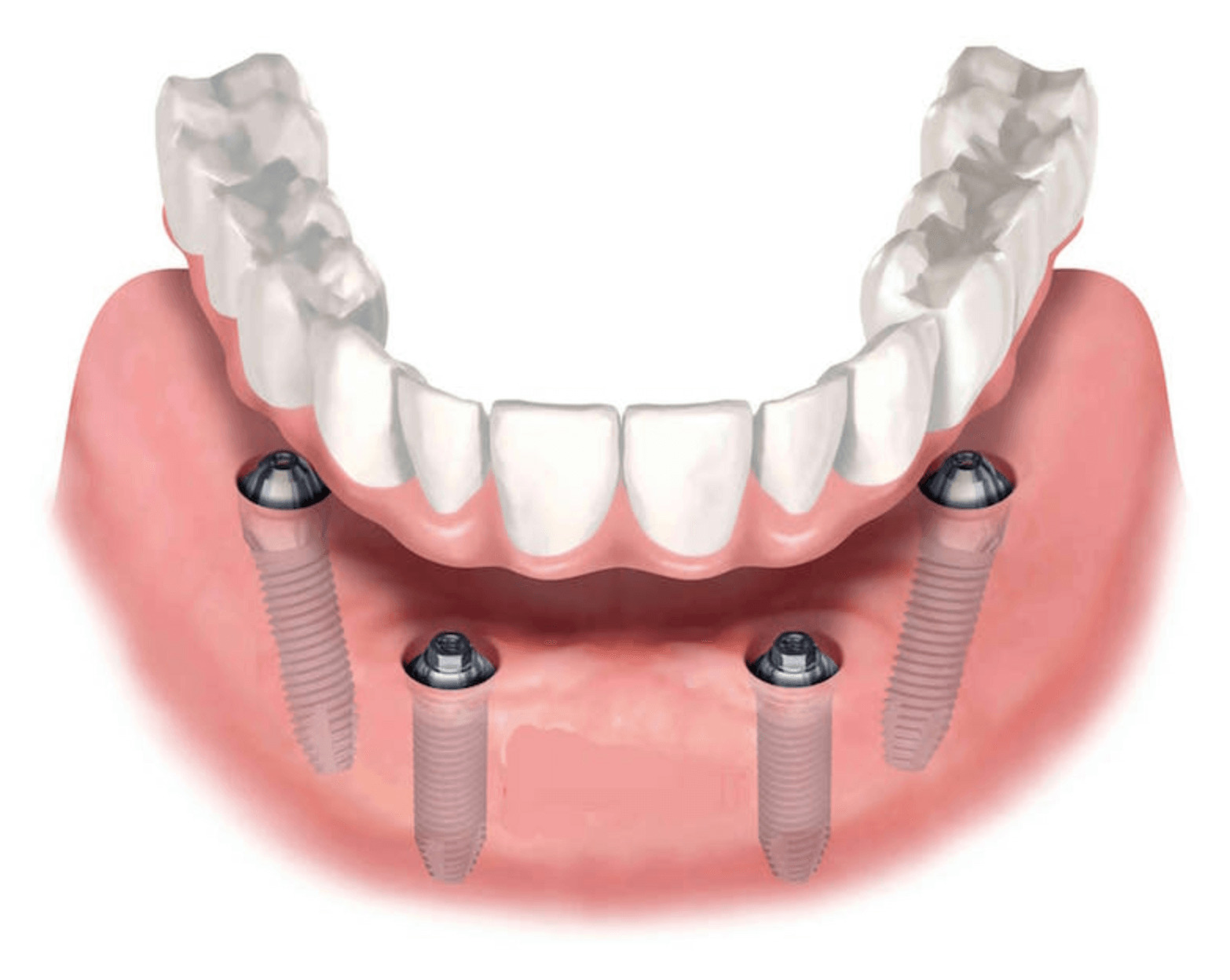 Имплантация зубов под ключ методом all-on-4