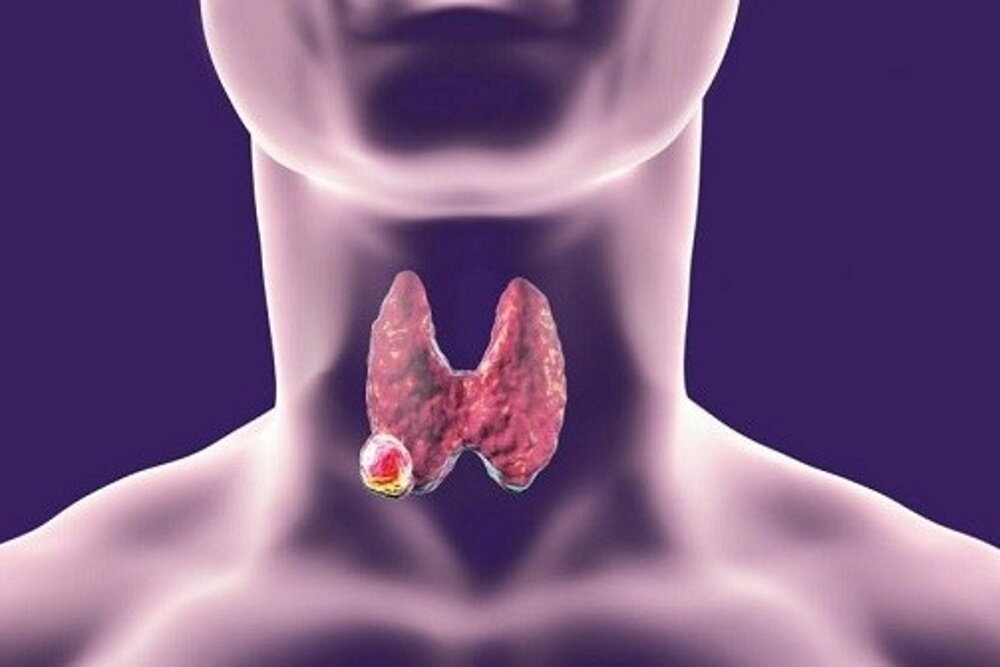 Как лечится рак щитовидной железы?