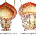 Эффективные методы лечения аденомы простаты: современные подходы к проблеме